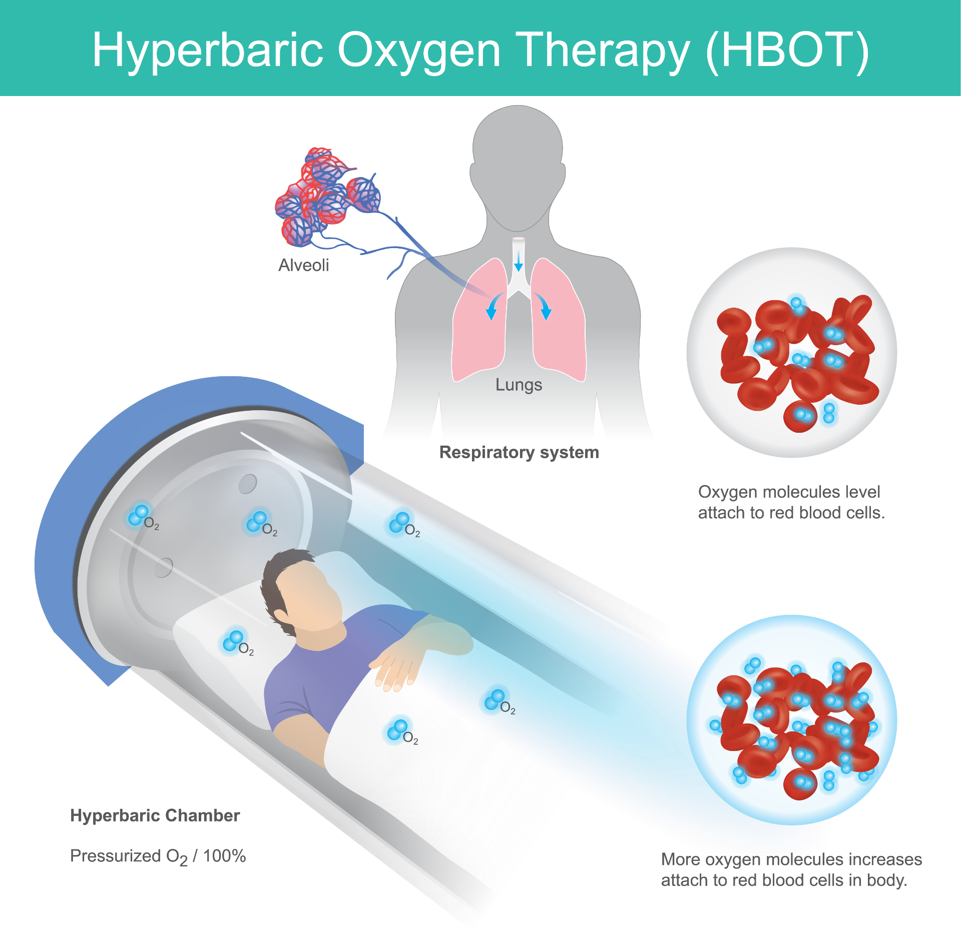 advanced-hbot-wound-care-norcal-hyperbaric